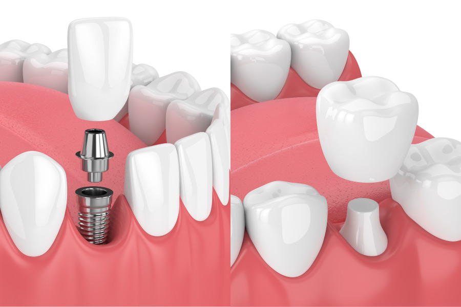Breaking Down Barriers: How Dental Crowns Can Restore Your Smile